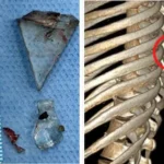 Glass shard hidden in Kerala woman’s back removed after 12 years of mystery and pain | Kerala News | ACTPnews